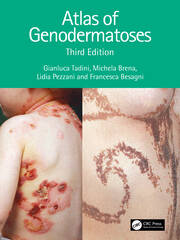 Atlas of Genodermatoses book cover