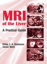 MRI of the Liver: A Practical Guide book cover
