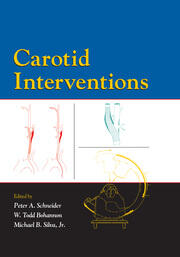 Carotid Interventions book cover