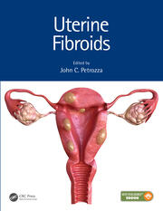 Uterine Fibroids book cover