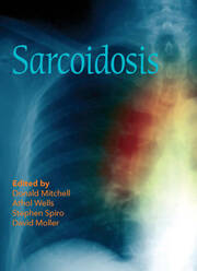 Sarcoidosis book cover