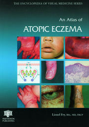An Atlas of Atopic Eczema book cover