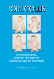 Torticollis: Differential Diagnosis, Assessment and Treatment, Surgical Management and Bracing book cover