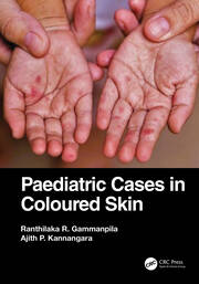 Paediatric Cases in Coloured Skin book cover
