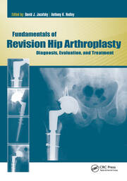 Fundamentals of Revision Hip Arthroplasty: Diagnosis, Evaluation, and Treatment book cover