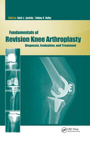 Fundamentals of Revision Knee Arthroplasty: Diagnosis, Evaluation, and Treatment book cover