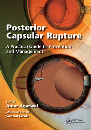 Posterior Capsular Rupture: A Practical Guide to Prevention and Management book cover