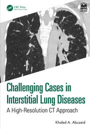 Challenging Cases in Interstitial Lung Diseases: A High-Resolution CT Approach book cover