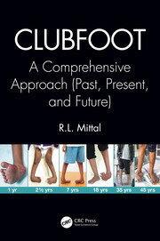 Clubfoot: A Comprehensive Approach (Past, Present, and Future) book cover