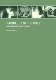 Radiology of the Chest and Related Conditions book cover