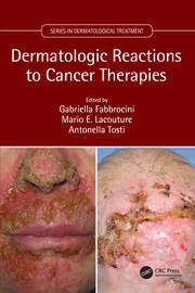 Dermatologic Reactions to Cancer Therapies book cover