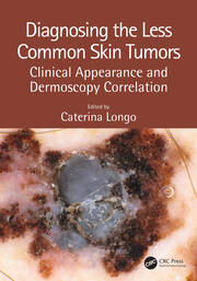 Diagnosing the Less Common Skin Tumors: Clinical Appearance and Dermoscopy Correlation book cover