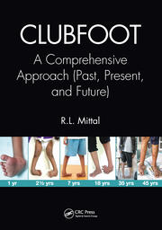 Clubfoot: A Comprehensive Approach (Past, Present, and Future) book cover