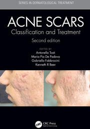 Acne Scars: Classification and Treatment, Second Edition book cover