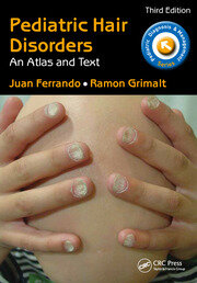 Pediatric Hair Disorders: An Atlas and Text, Third Edition book cover