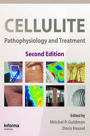 Cellulite: Pathophysiology and Treatment book cover